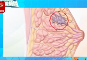乳腺癌的症状有哪些？出现这些症状的女性同胞要注意啦！